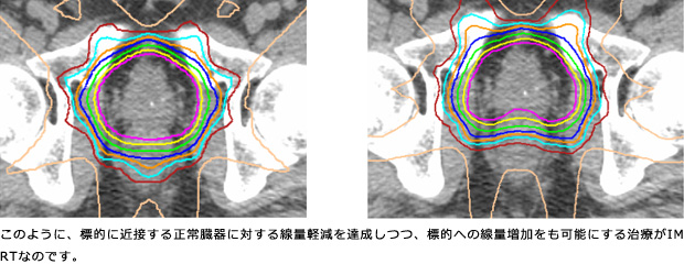 このように、標的に近接する正常臓器に対する線量軽減を達成しつつ、標的への線量増加をも可能にする治療がIMRTなのです。